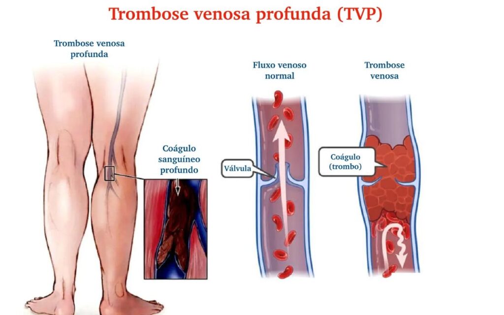 1.000 pessoas-ano nos pacientes com varizes, contra 1,23 nos controles. Análises