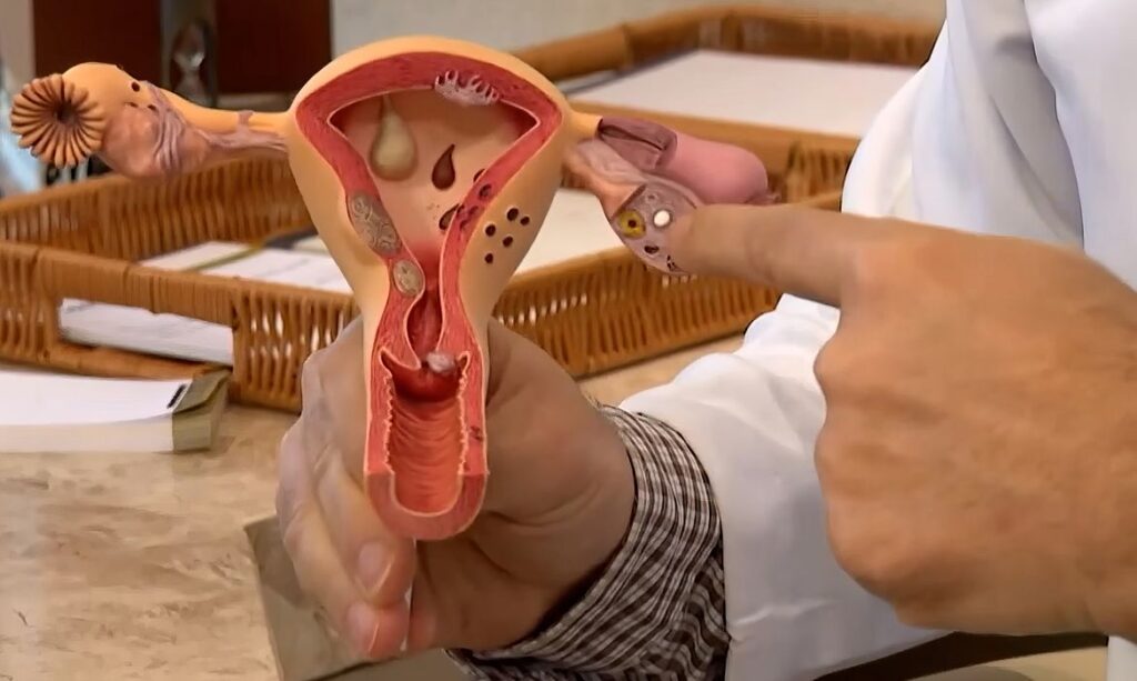 Edital de R$ 60 milhões busca inovações para endometriose e saúde menstrual no SUS