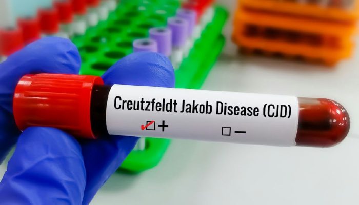 Ciência corre contra o tempo para tratar a rara e fatal doença de Creutzfeldt-jakob