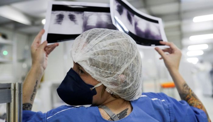 Diagnóstico avançado em 90% dos casos de câncer de pulmão no SUS reduz drasticamente a cura