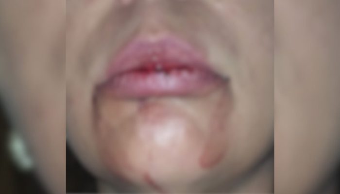 A mulher sofreu um corte no lábio inferior Polícia Militar/reprodução