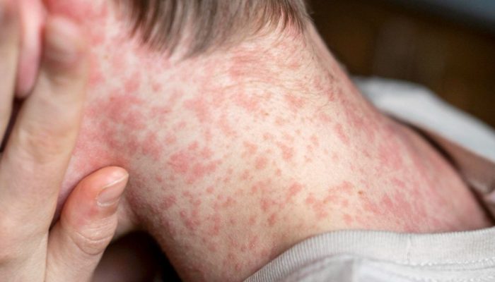Sarampo em alerta: entenda os riscos de reintrodução da doença no Brasil