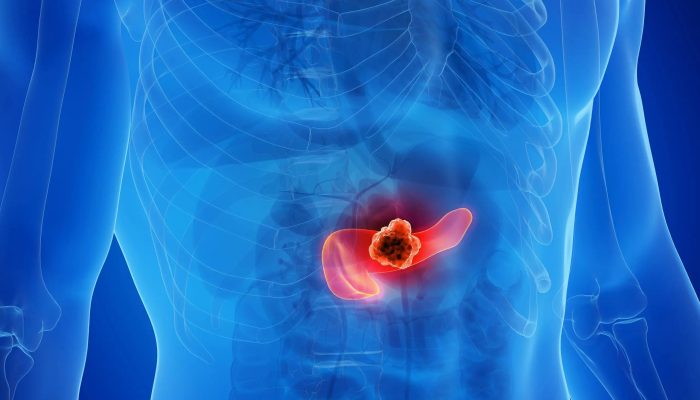 Vinte mortes por câncer de pâncreas no Sul de Minas em 2026 acendem alerta para detecção tardia